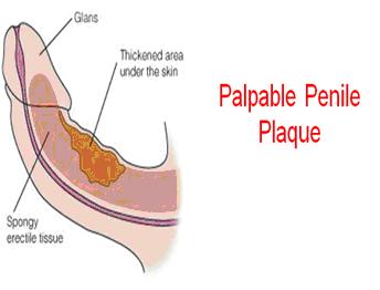 Palpable Penile Plaque