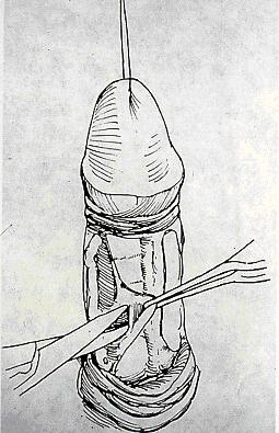 Dissection of neurovascular bundle