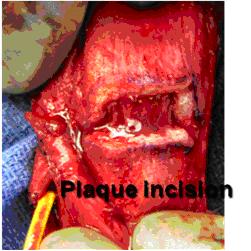 Plaque incision