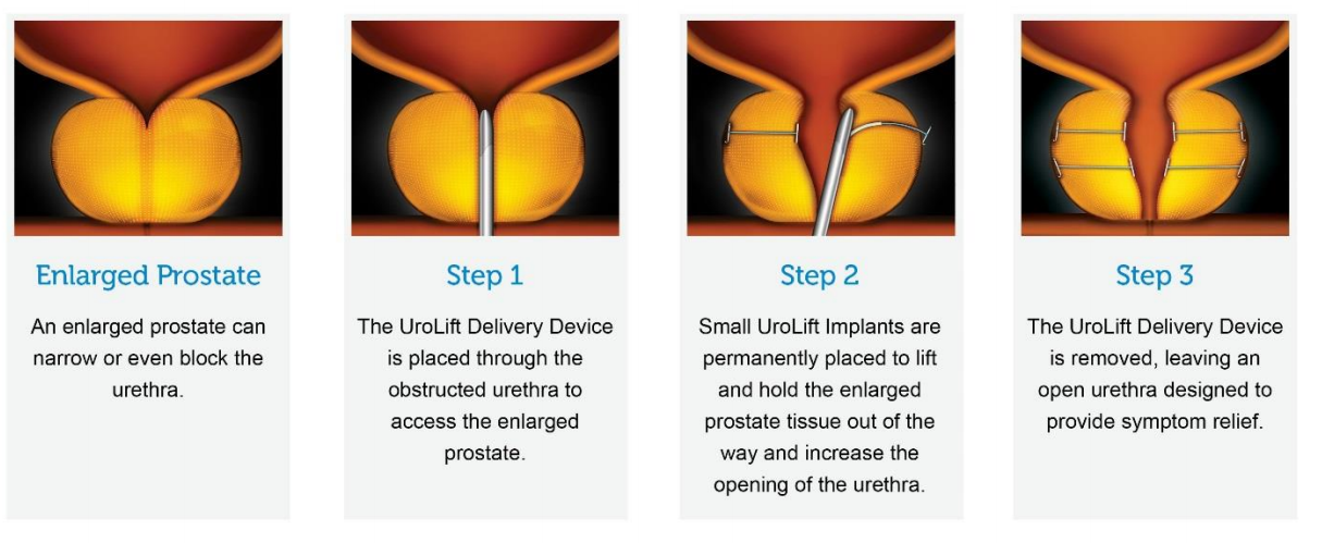 Prostate Steps