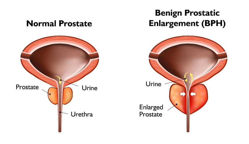 UROLIFT Prostate